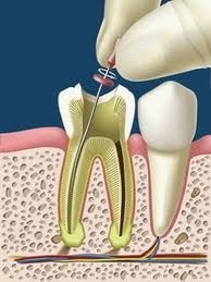 endodoncia endodoncia