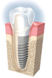 implant implant