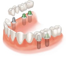 implants implants